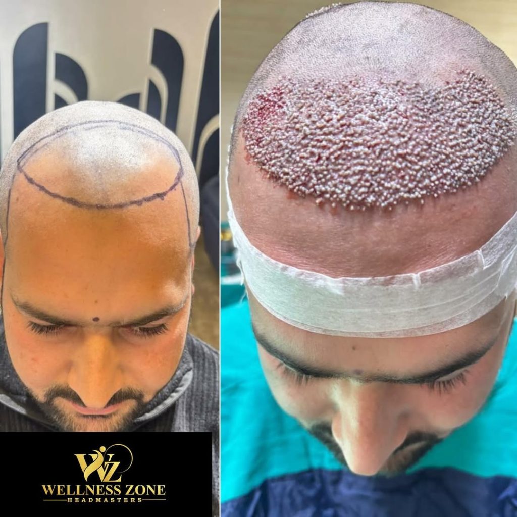 wzhm_hairtransplant-20260105-0001