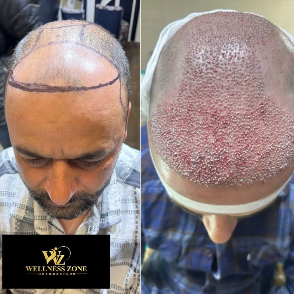 wzhm_hairtransplant-20260105-0002