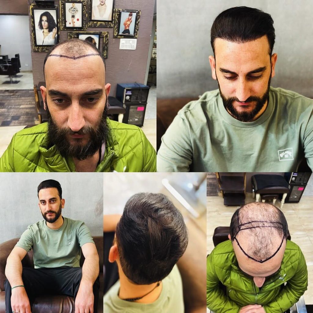 wzhm_hairtransplant-20260105-0003