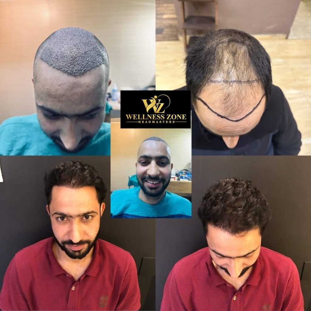wzhm_hairtransplant-20260105-0004