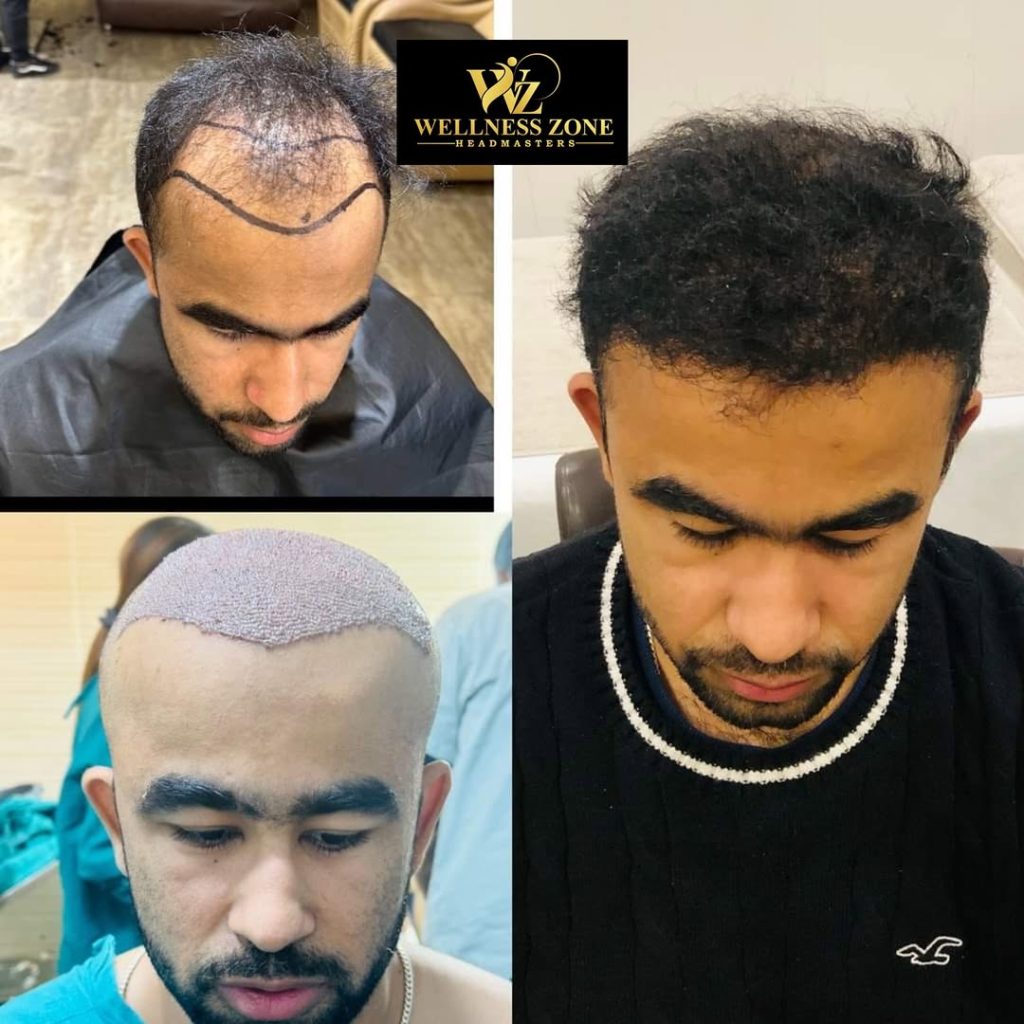 wzhm_hairtransplant-20260105-0005