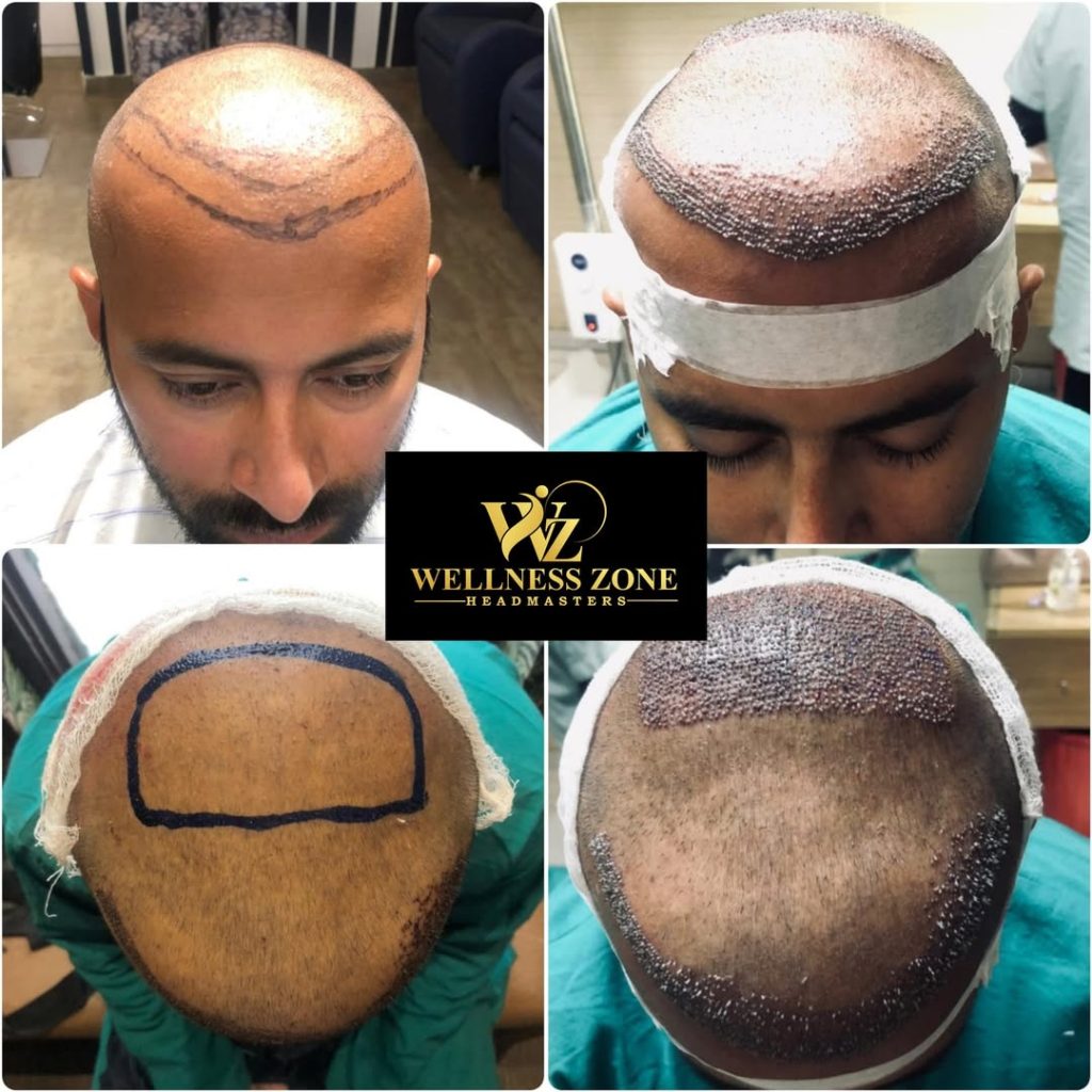wzhm_hairtransplant-20260105-0006