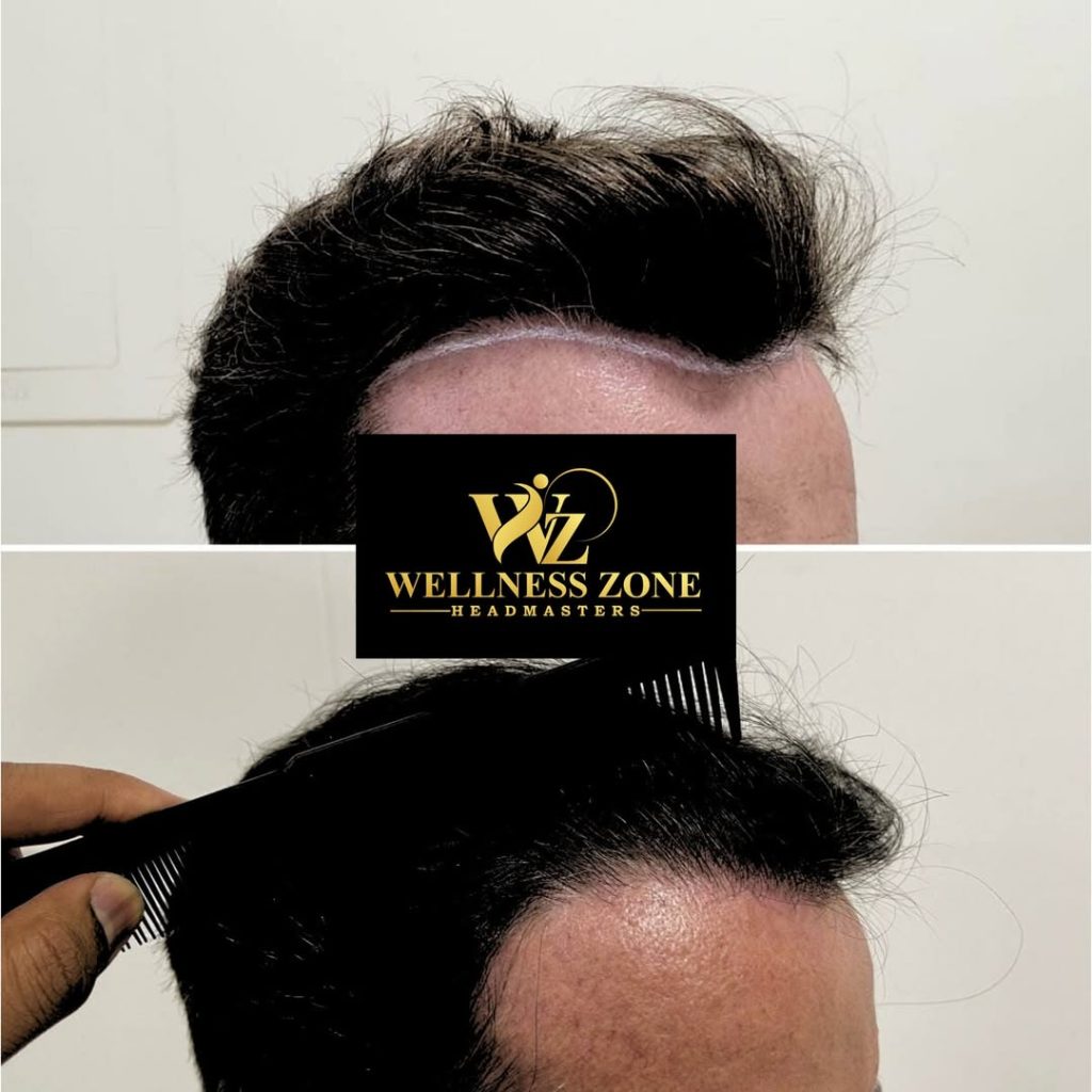 wzhm_hairtransplant-20260105-0007