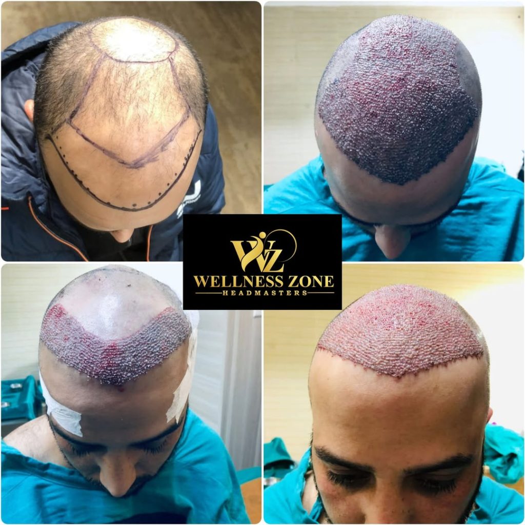 wzhm_hairtransplant-20260105-0008