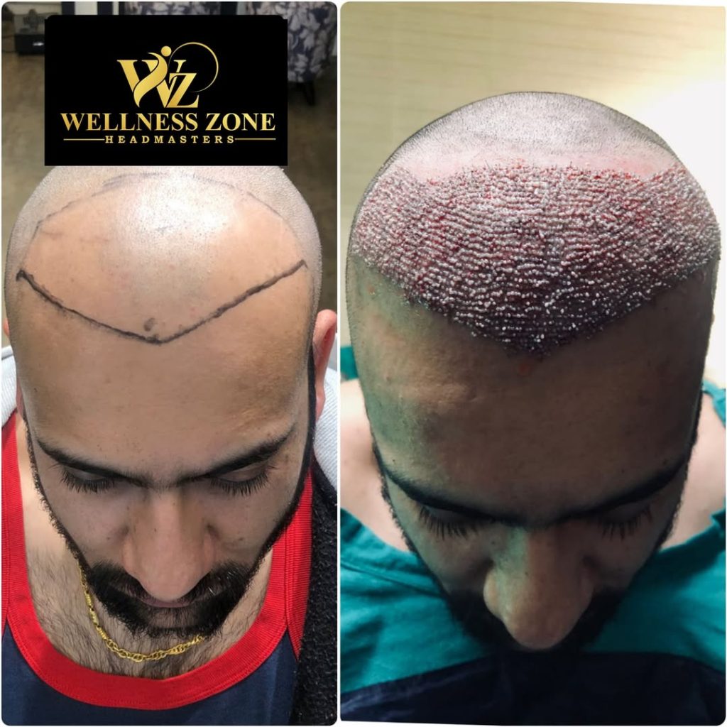 wzhm_hairtransplant-20260105-0009