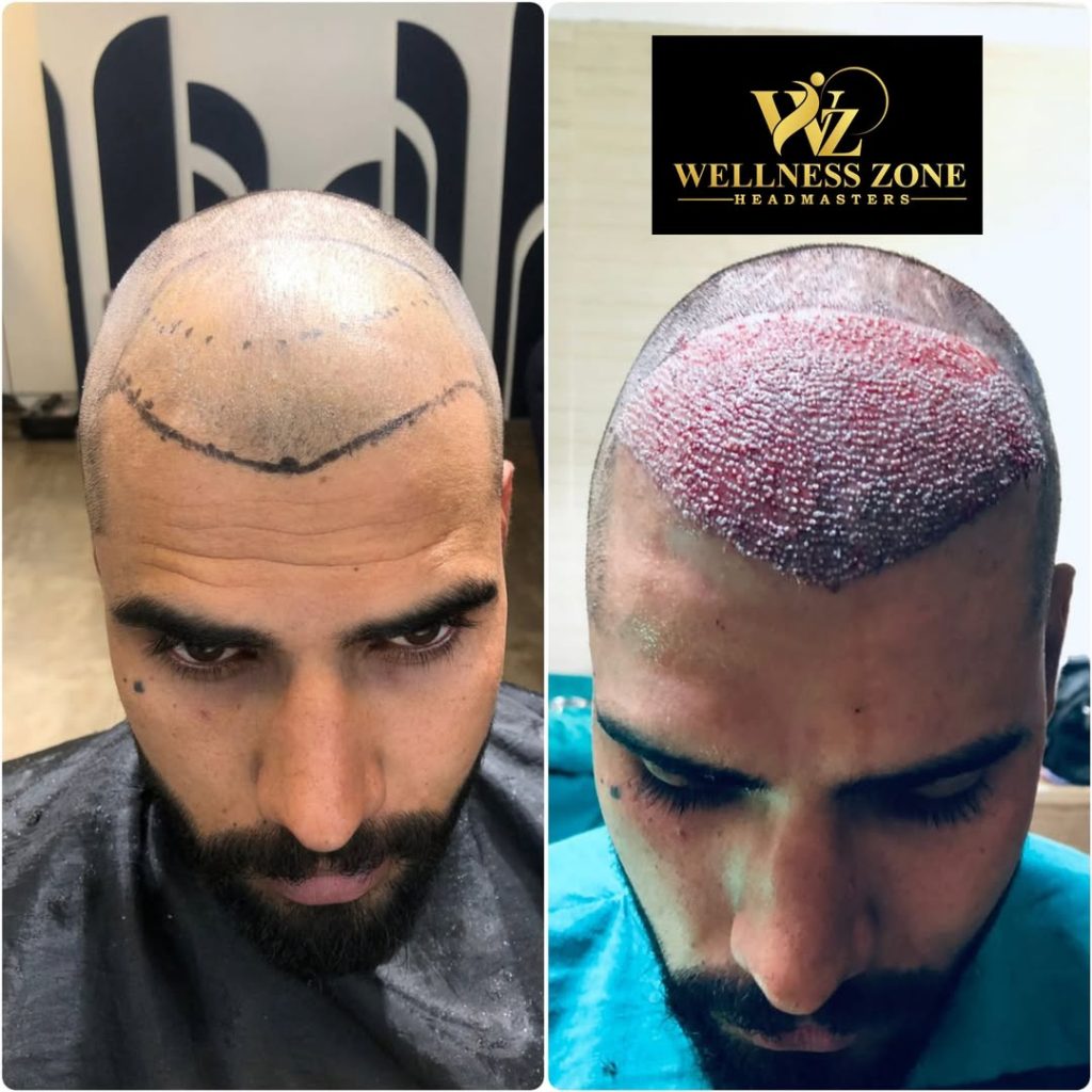 wzhm_hairtransplant-20260105-0010