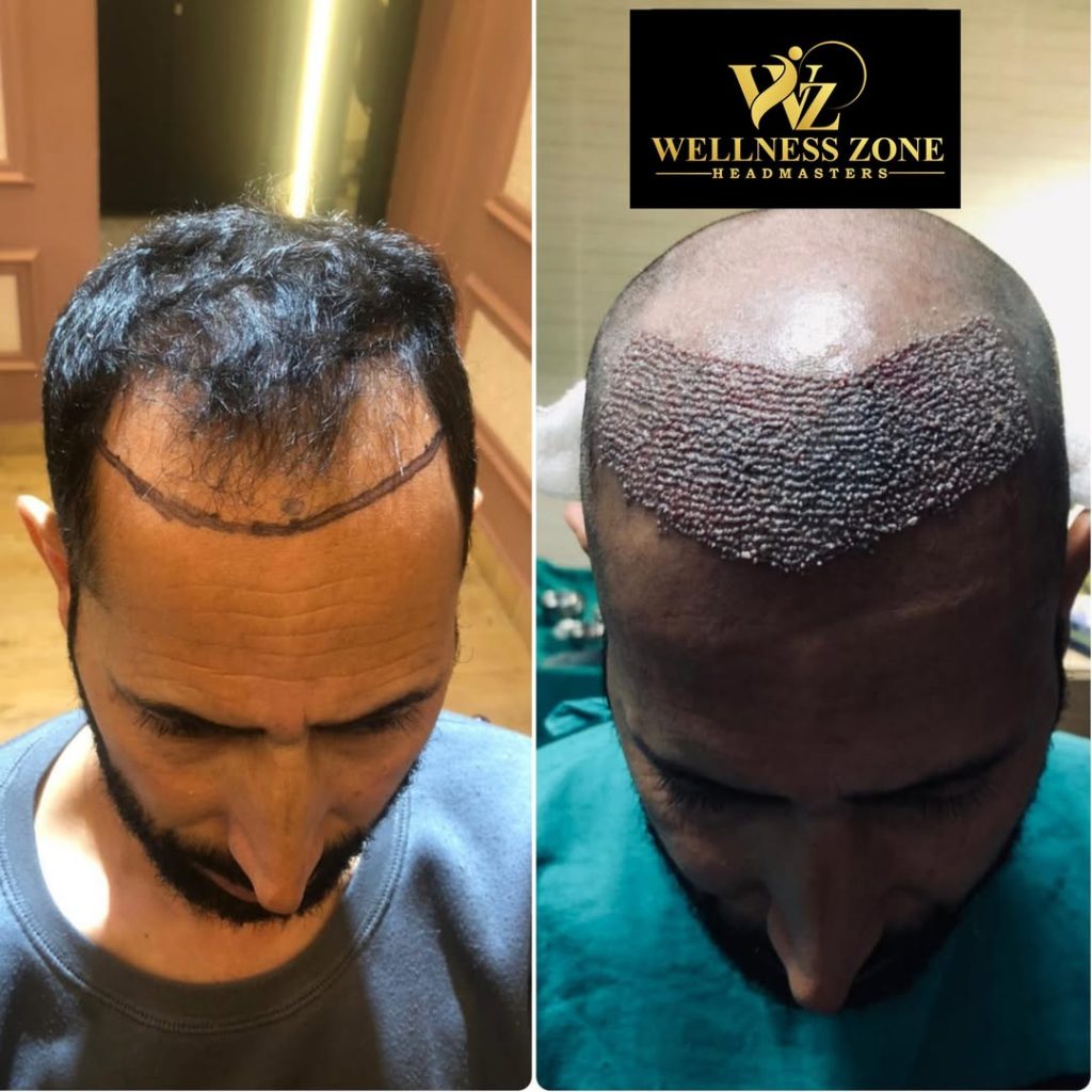 wzhm_hairtransplant-20260105-0011