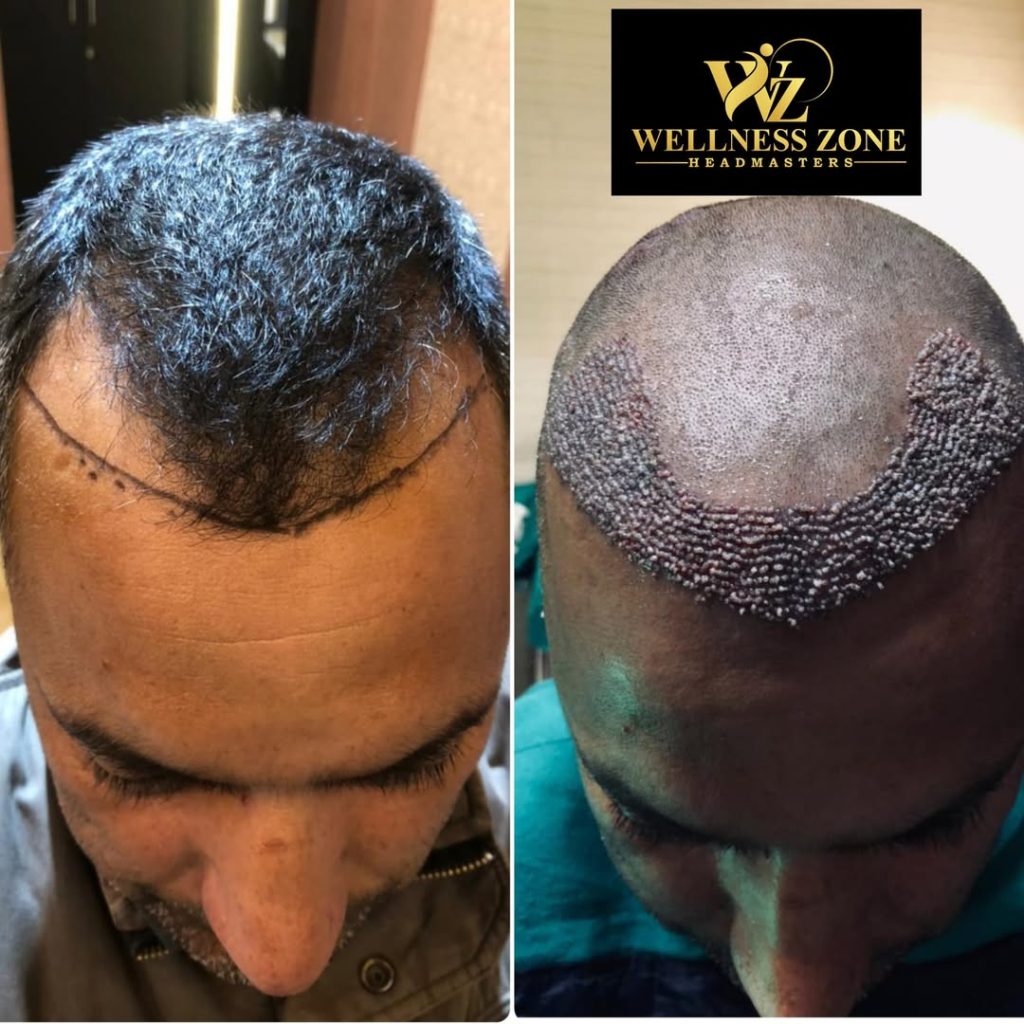 wzhm_hairtransplant-20260105-0012