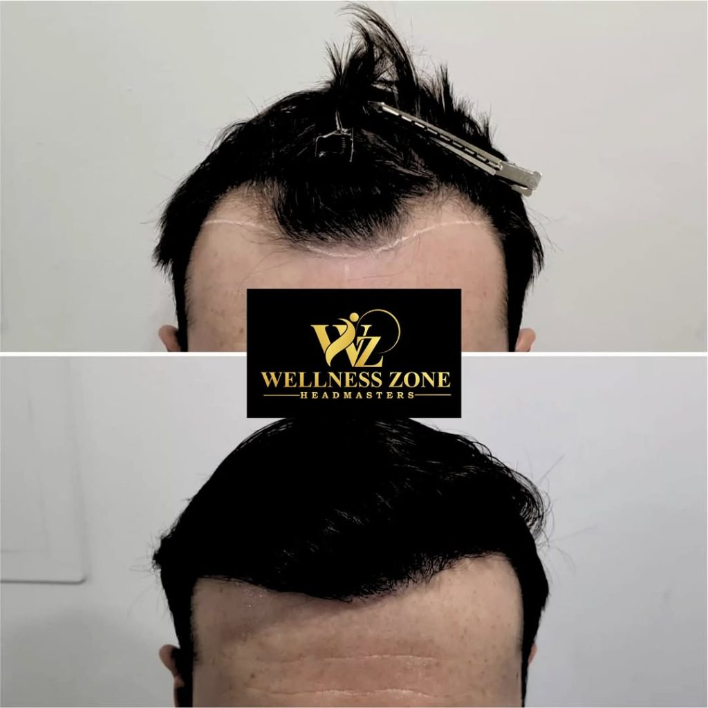 wzhm_hairtransplant-20260105-0013