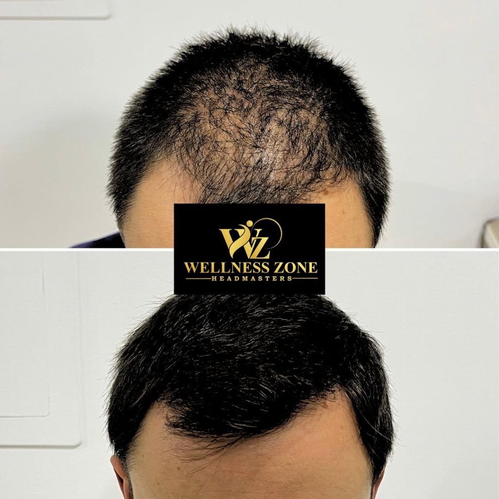 wzhm_hairtransplant-20260105-0014