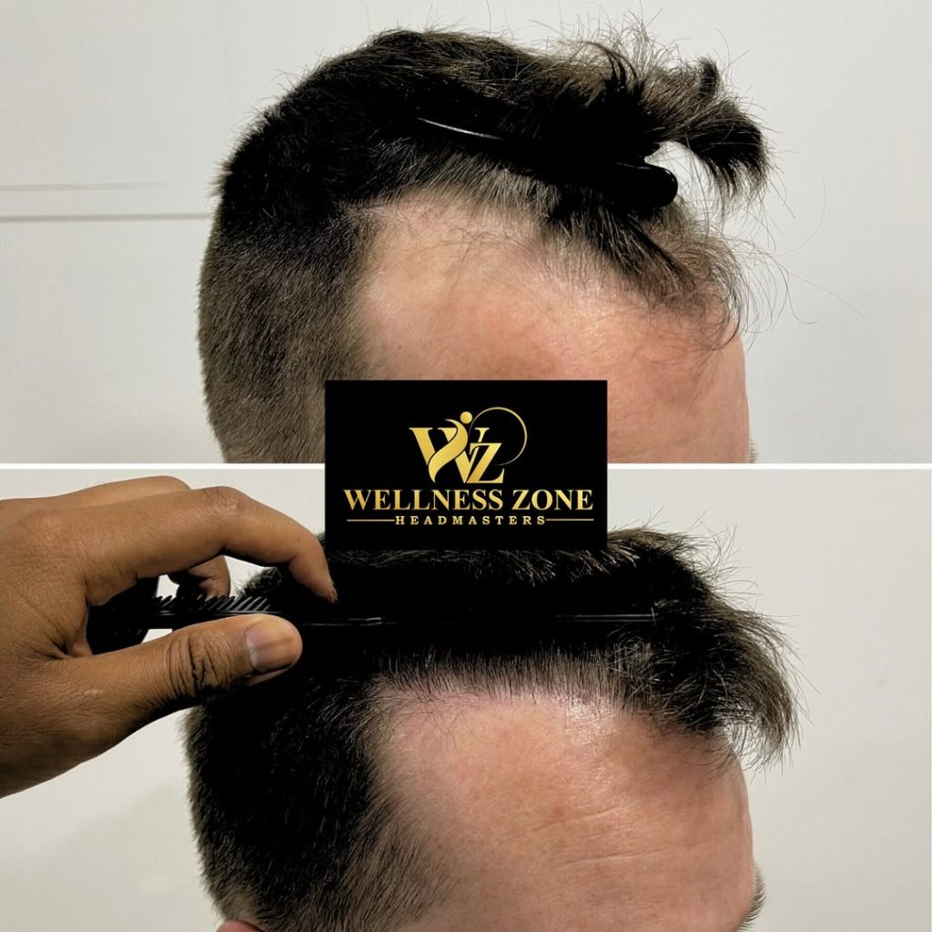 wzhm_hairtransplant-20260105-0015