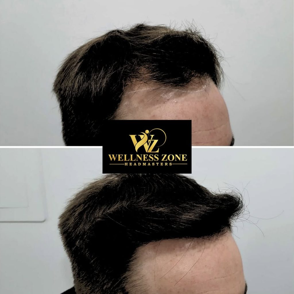 wzhm_hairtransplant-20260105-0016