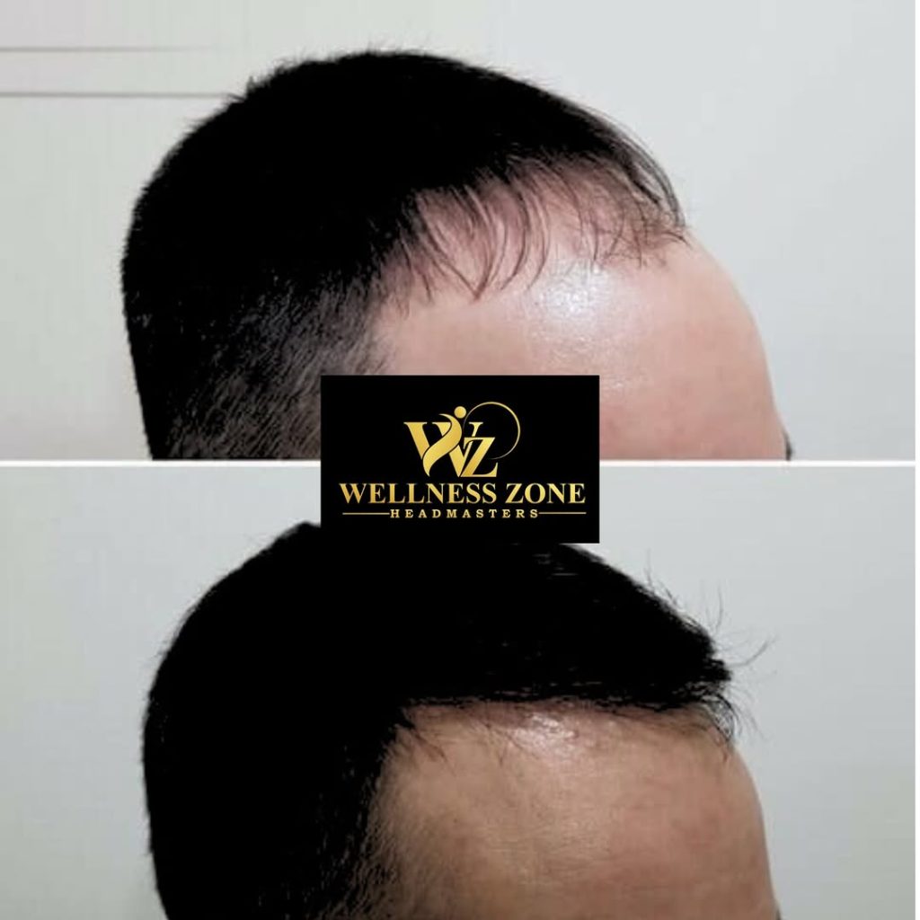 wzhm_hairtransplant-20260105-0017