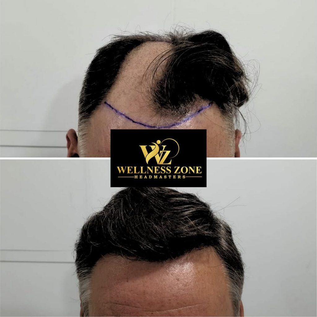 wzhm_hairtransplant-20260105-0018
