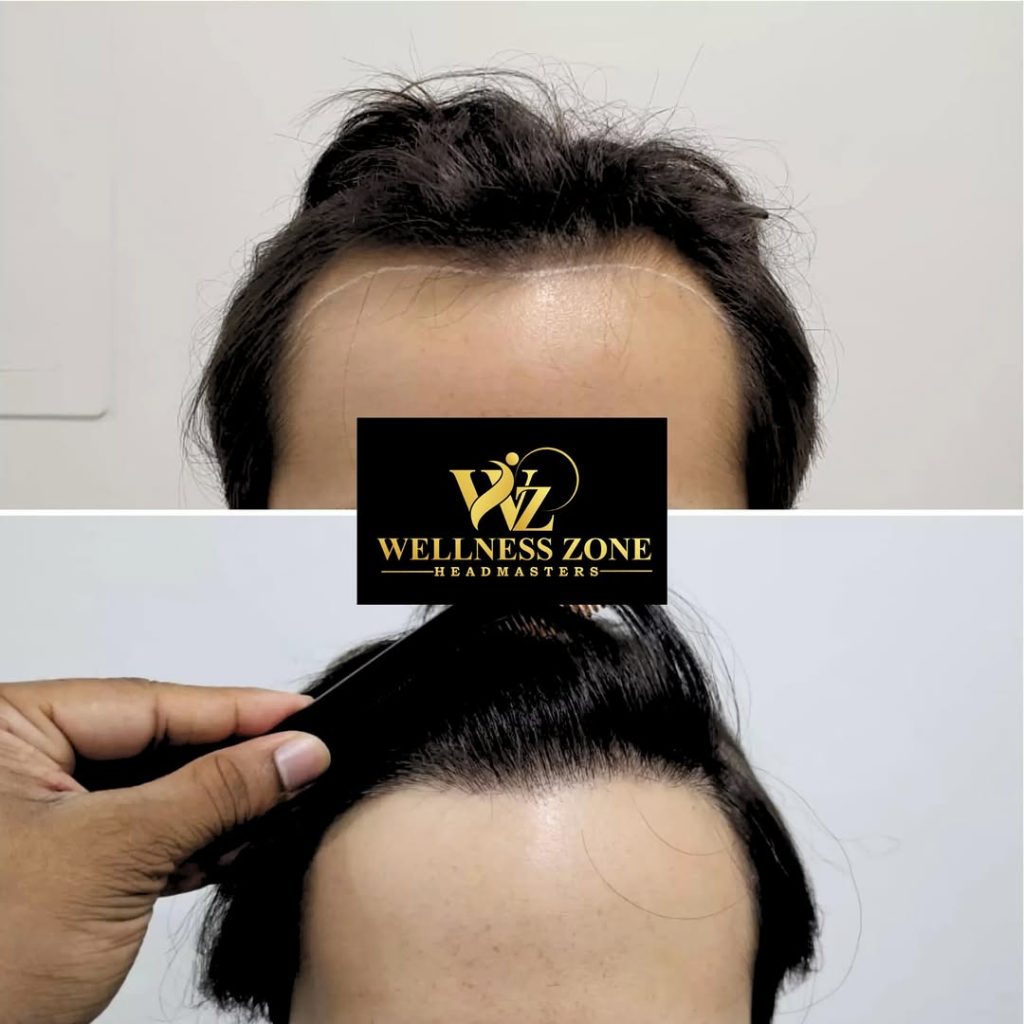 wzhm_hairtransplant-20260105-0019