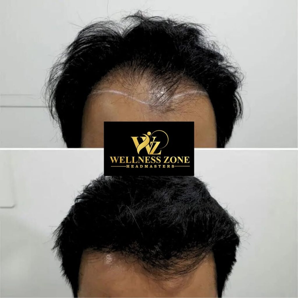 wzhm_hairtransplant-20260105-0020
