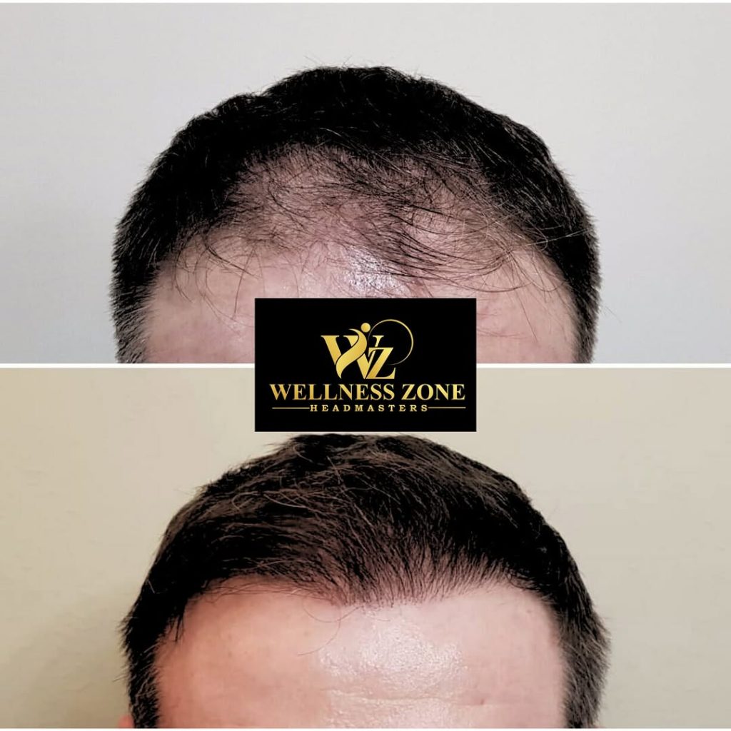wzhm_hairtransplant-20260105-0021