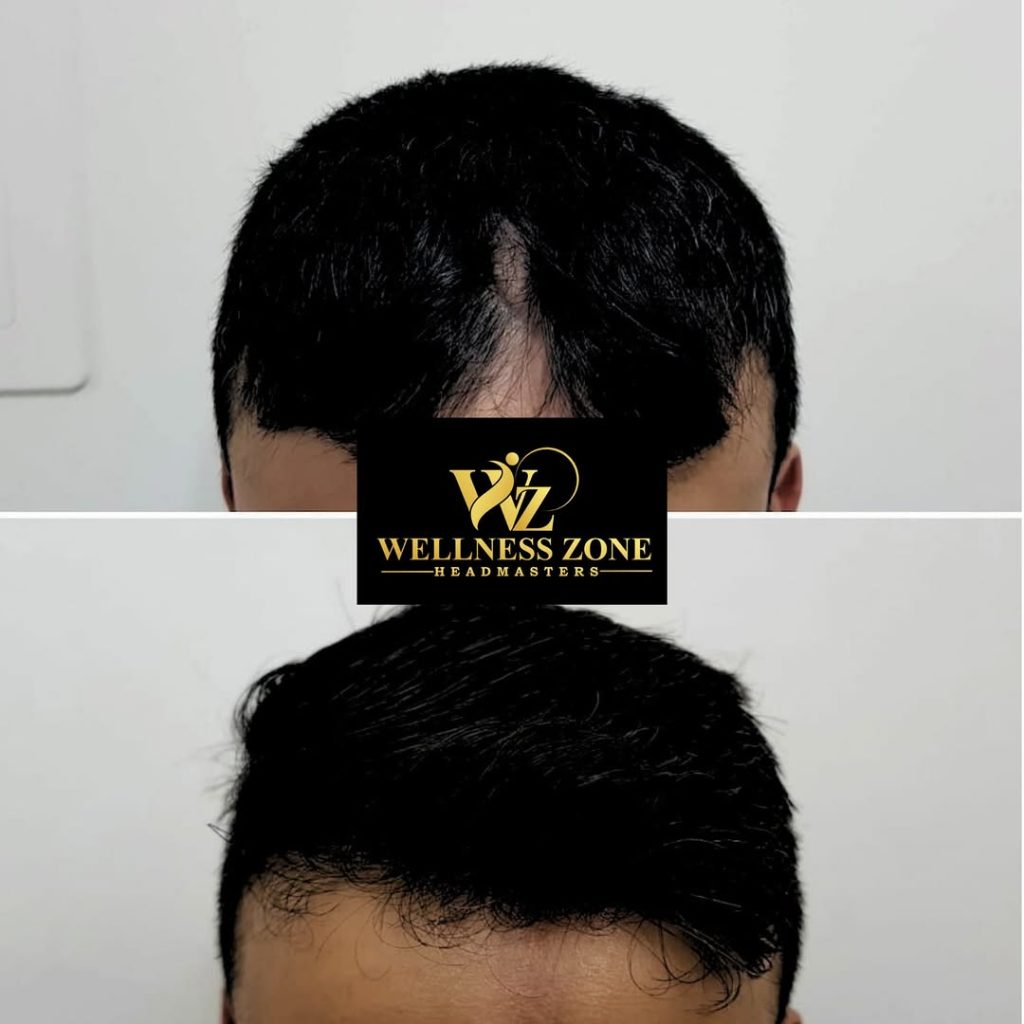 wzhm_hairtransplant-20260105-0022