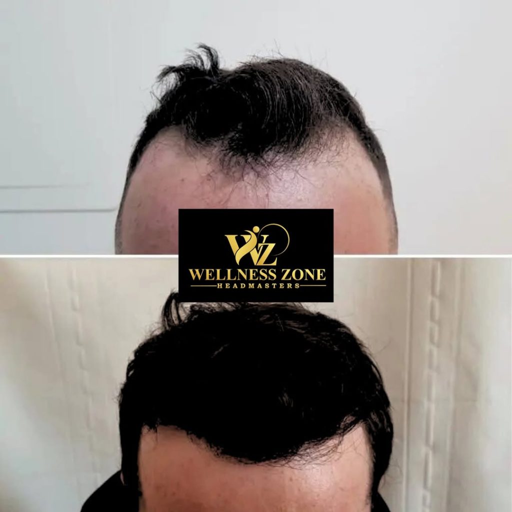 wzhm_hairtransplant-20260105-0023