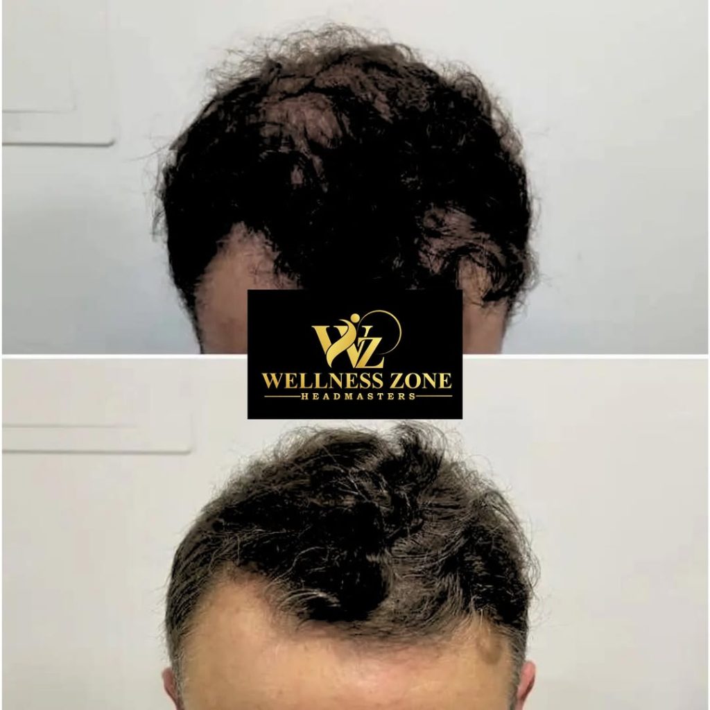 wzhm_hairtransplant-20260105-0024