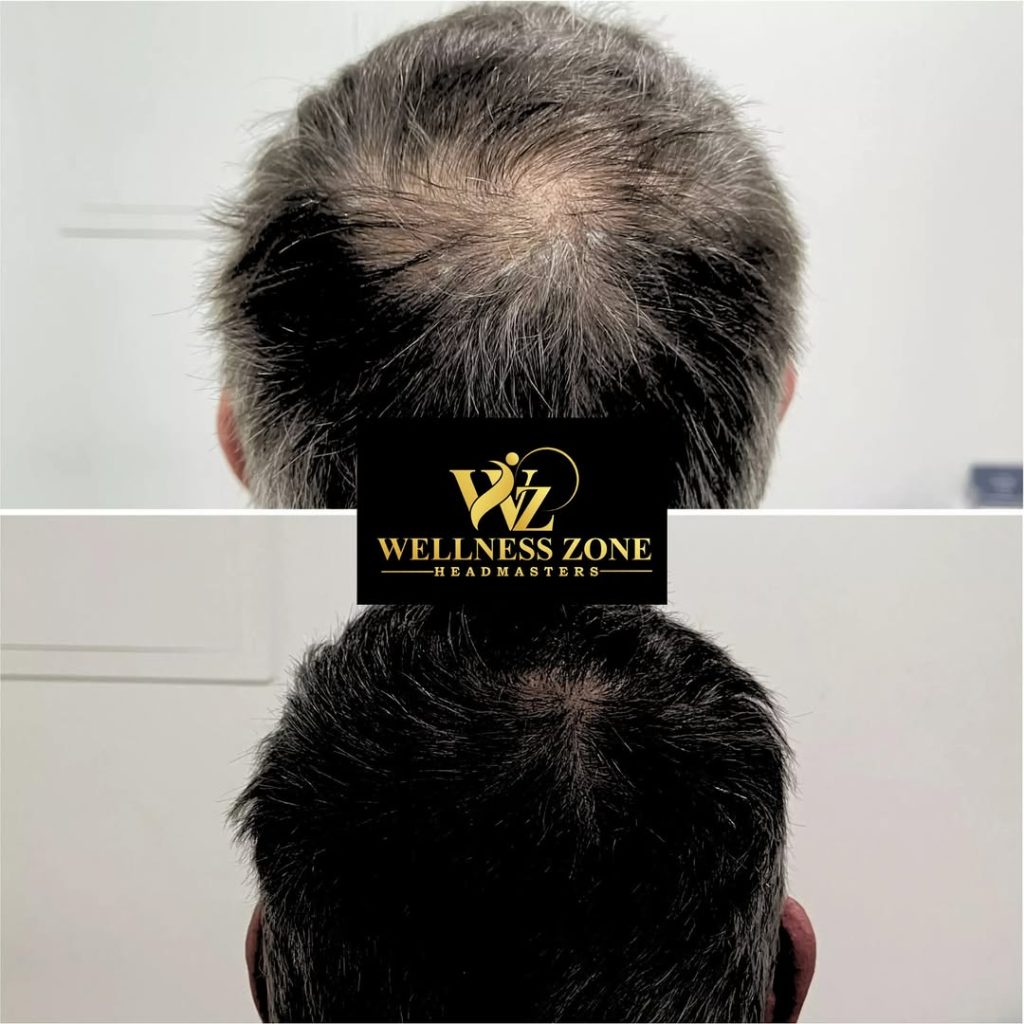 wzhm_hairtransplant-20260105-0025