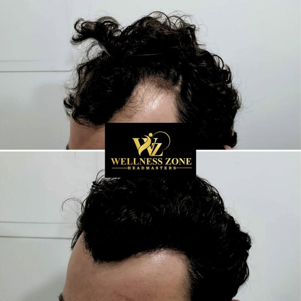wzhm_hairtransplant-20260105-0026