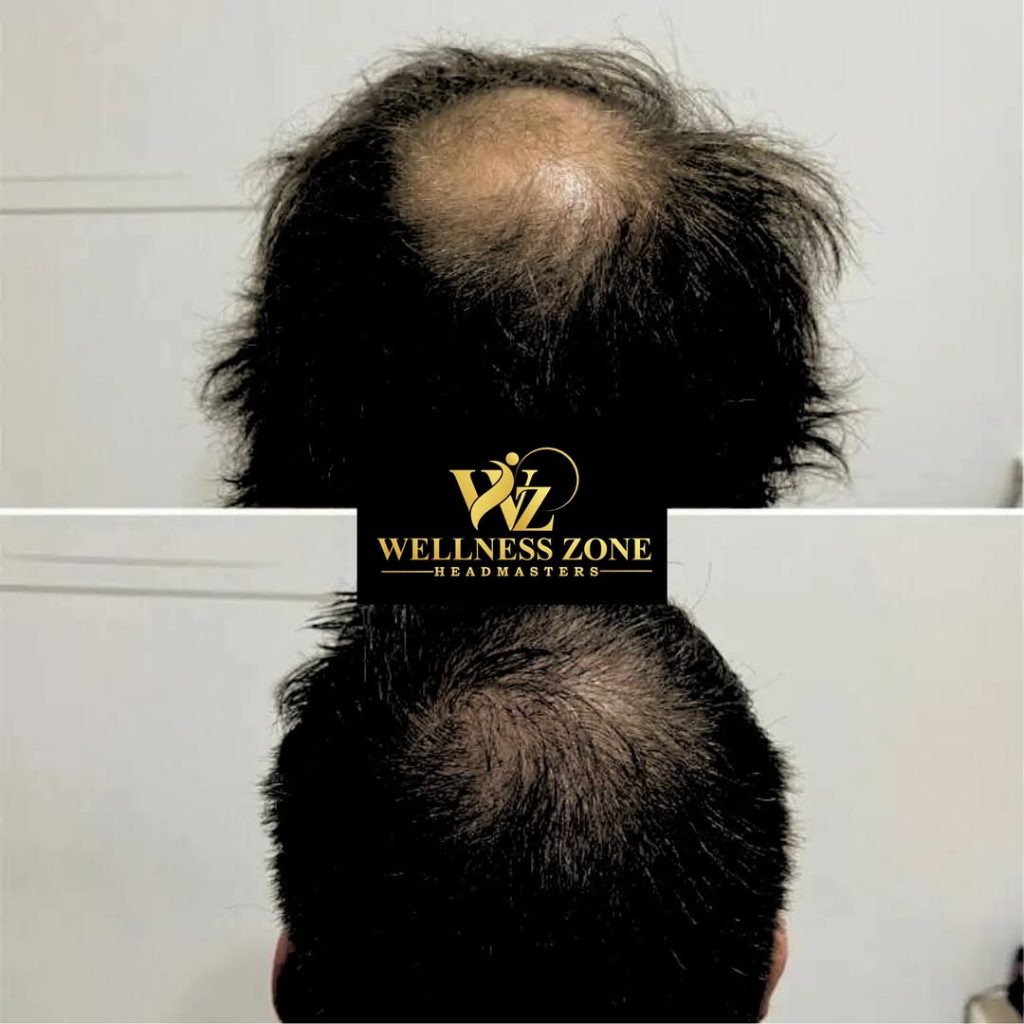 wzhm_hairtransplant-20260105-0027
