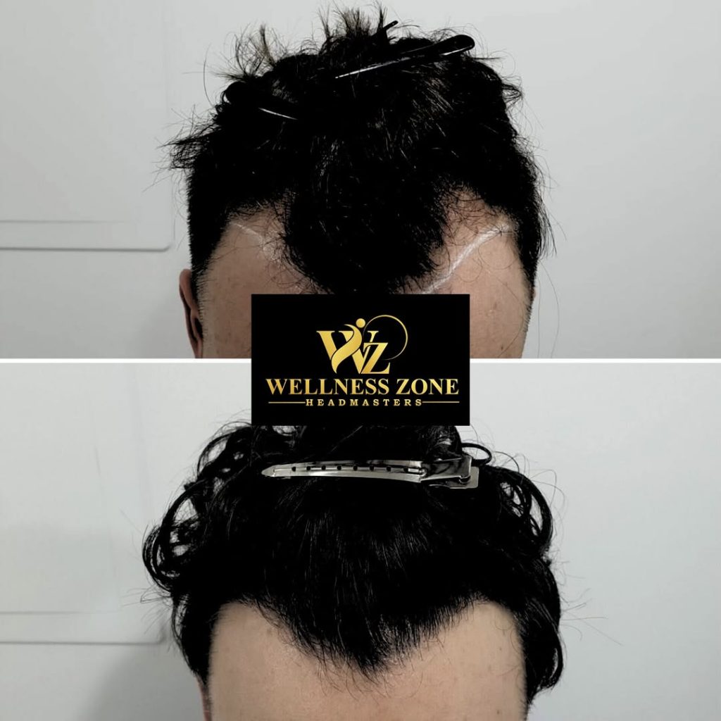 wzhm_hairtransplant-20260105-0028